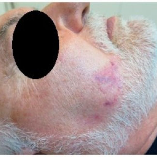Tratamiento angioma